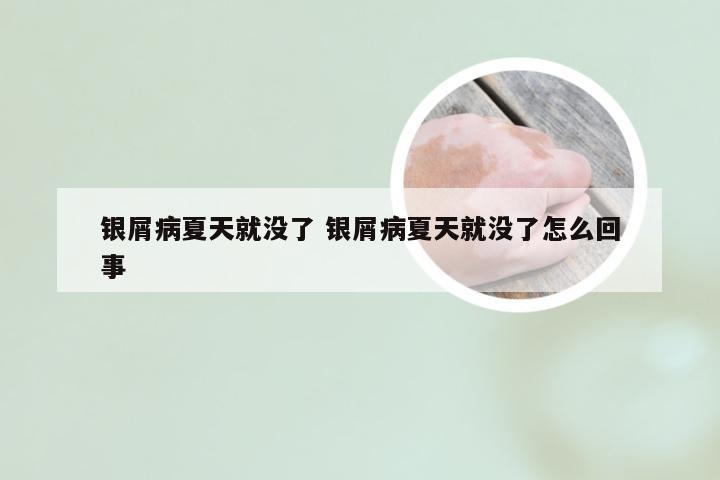 银屑病夏天就没了 银屑病夏天就没了怎么回事