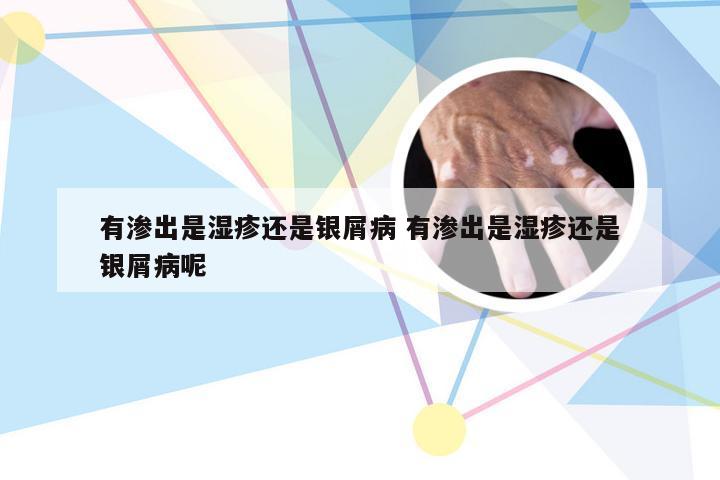 有渗出是湿疹还是银屑病 有渗出是湿疹还是银屑病呢