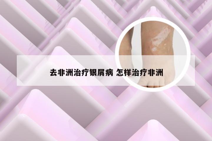 去非洲治疗银屑病 怎样治疗非洲
