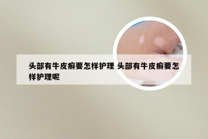 头部有牛皮癣要怎样护理 头部有牛皮癣要怎样护理呢