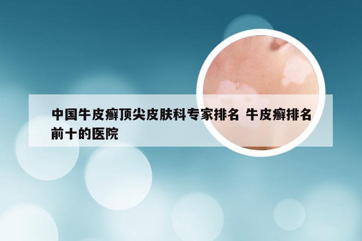 中国牛皮癣顶尖皮肤科专家排名 牛皮癣排名前十的医院