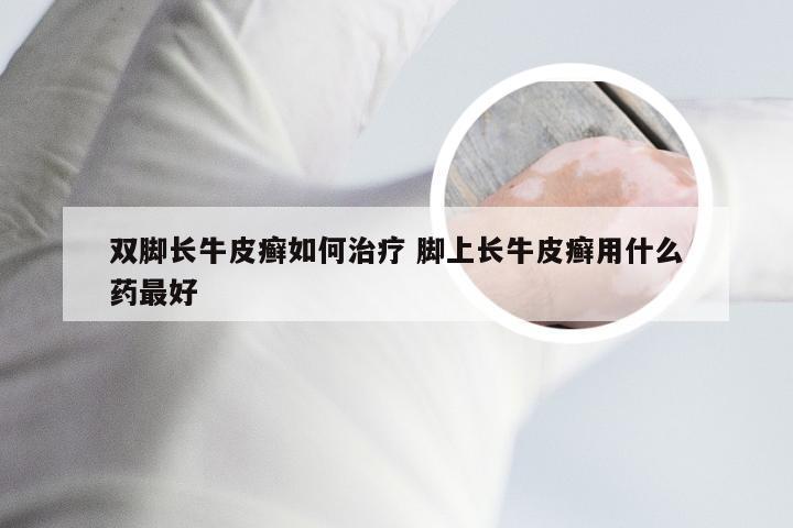 双脚长牛皮癣如何治疗 脚上长牛皮癣用什么药最好
