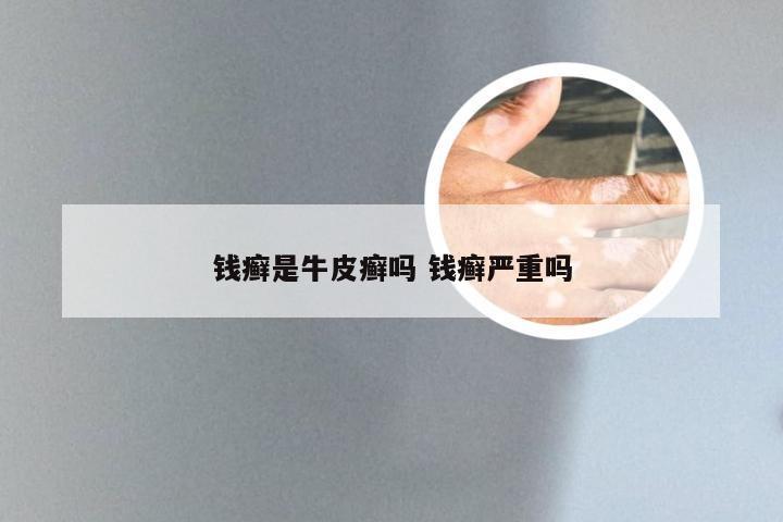 钱癣是牛皮癣吗 钱癣严重吗