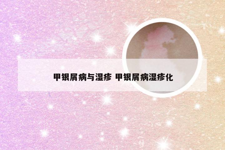甲银屑病与湿疹 甲银屑病湿疹化