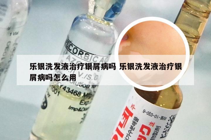 乐银洗发液治疗银屑病吗 乐银洗发液治疗银屑病吗怎么用