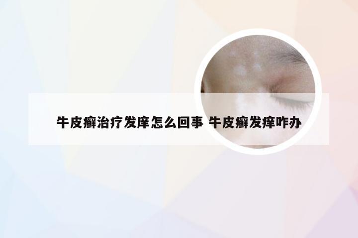 牛皮癣治疗发庠怎么回事 牛皮癣发痒咋办