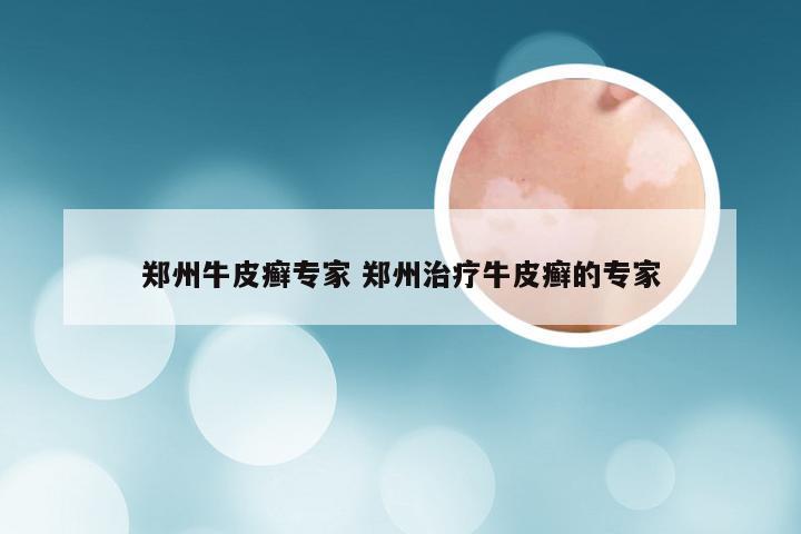 郑州牛皮癣专家 郑州治疗牛皮癣的专家