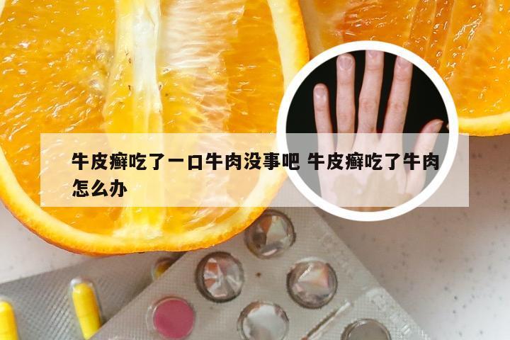 牛皮癣吃了一口牛肉没事吧 牛皮癣吃了牛肉怎么办