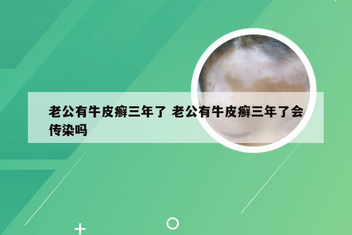 老公有牛皮癣三年了 老公有牛皮癣三年了会传染吗