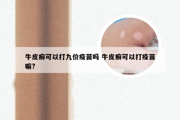 牛皮癣可以打九价疫苗吗 牛皮癣可以打疫苗嘛?