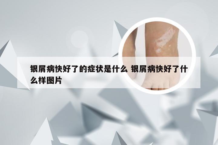 银屑病快好了的症状是什么 银屑病快好了什么样图片