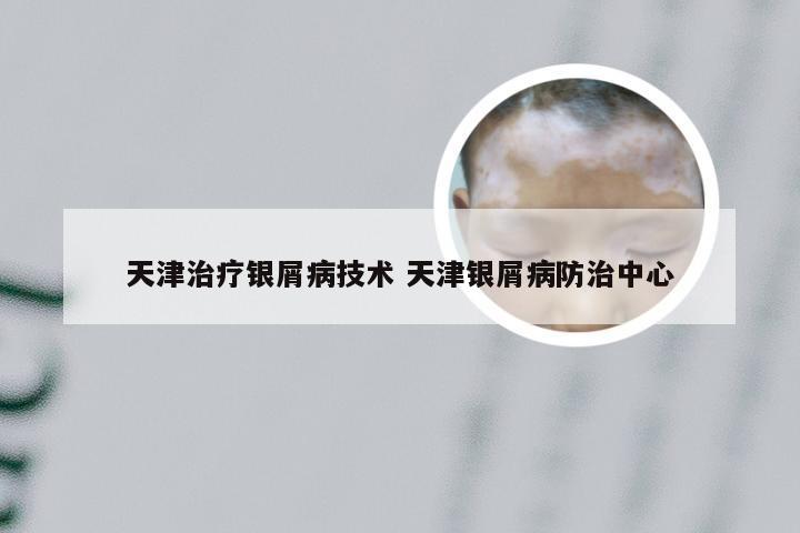 天津治疗银屑病技术 天津银屑病防治中心