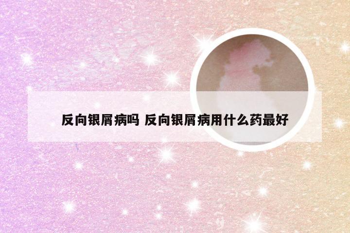 反向银屑病吗 反向银屑病用什么药最好