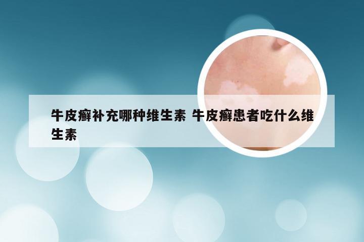 牛皮癣补充哪种维生素 牛皮癣患者吃什么维生素