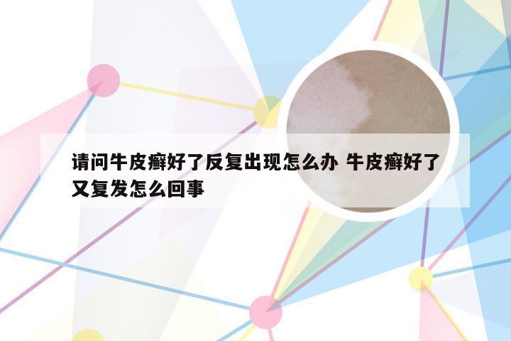 请问牛皮癣好了反复出现怎么办 牛皮癣好了又复发怎么回事