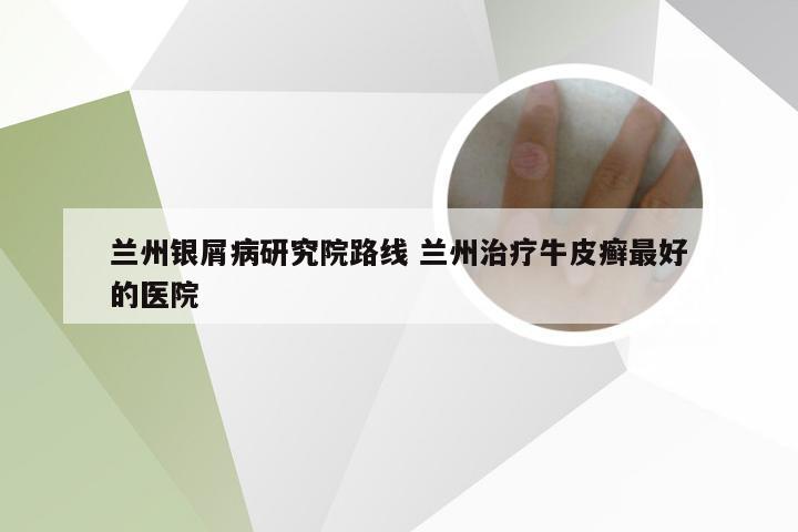 兰州银屑病研究院路线 兰州治疗牛皮癣最好的医院