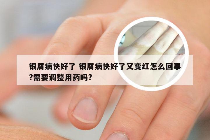 银屑病快好了 银屑病快好了又变红怎么回事?需要调整用药吗?