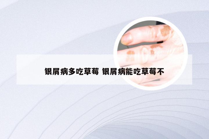 银屑病多吃草莓 银屑病能吃草莓不