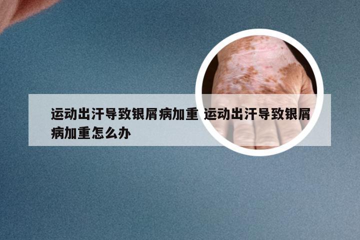 运动出汗导致银屑病加重 运动出汗导致银屑病加重怎么办