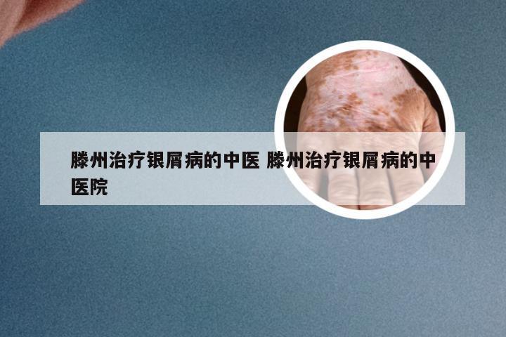滕州治疗银屑病的中医 滕州治疗银屑病的中医院