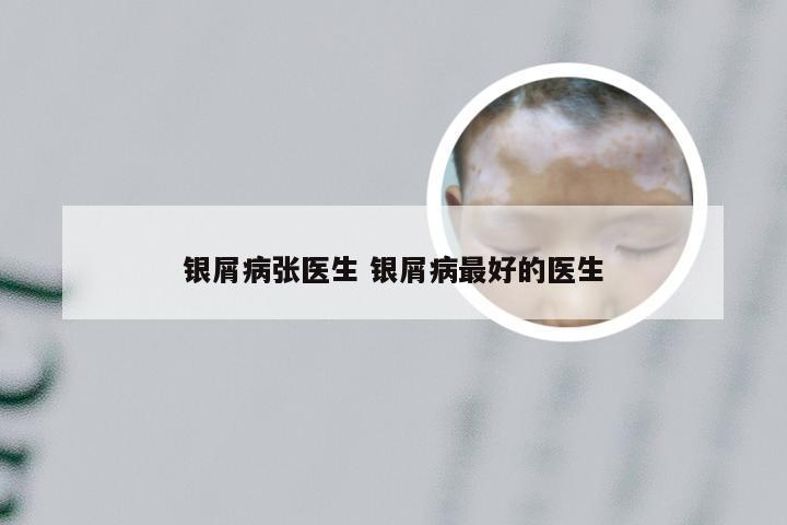银屑病张医生 银屑病最好的医生