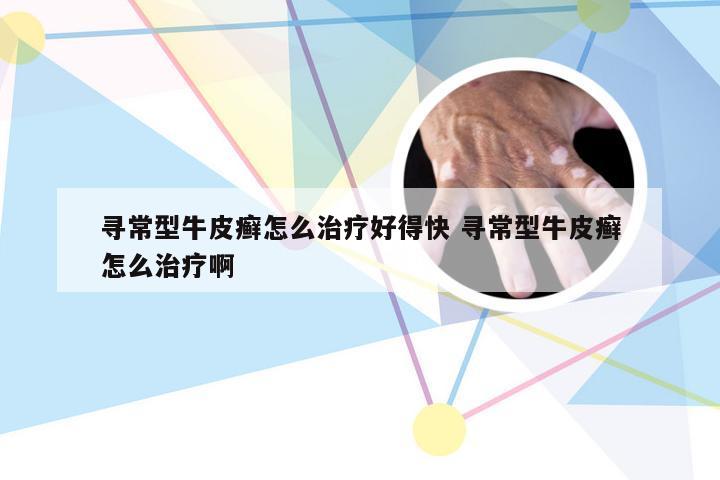 寻常型牛皮癣怎么治疗好得快 寻常型牛皮癣怎么治疗啊