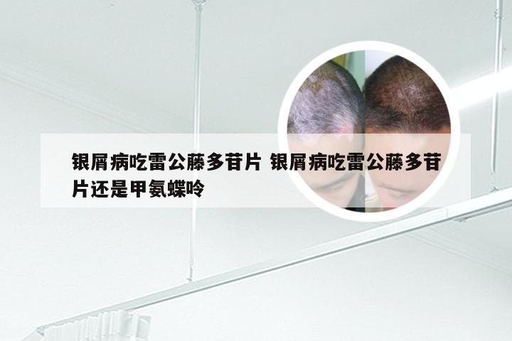 银屑病吃雷公藤多苷片 银屑病吃雷公藤多苷片还是甲氨蝶呤