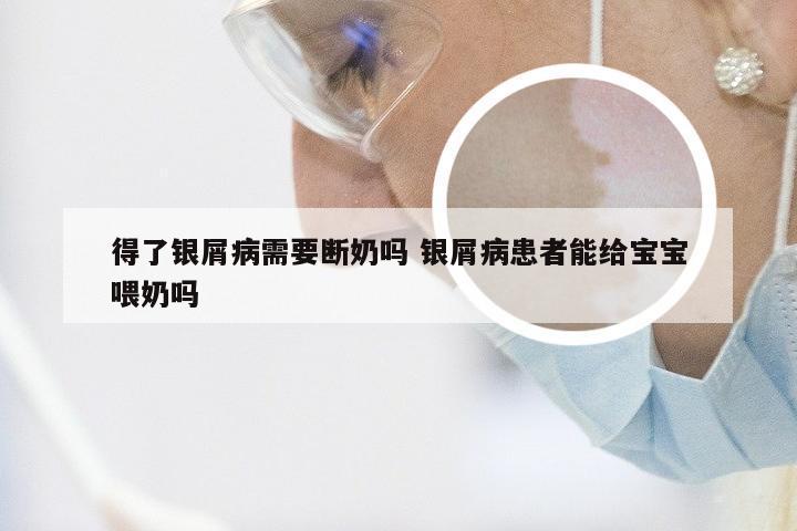 得了银屑病需要断奶吗 银屑病患者能给宝宝喂奶吗