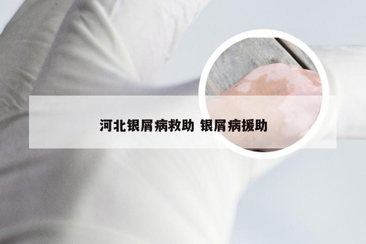 河北银屑病救助 银屑病援助