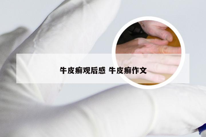 牛皮癣观后感 牛皮癣作文