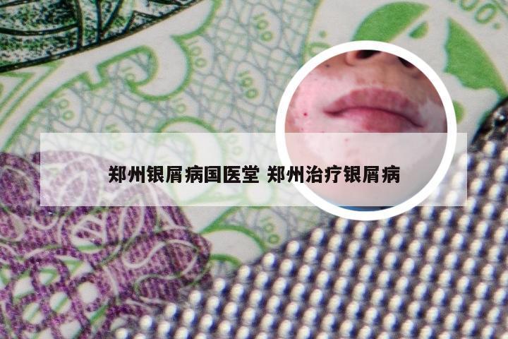 郑州银屑病国医堂 郑州治疗银屑病