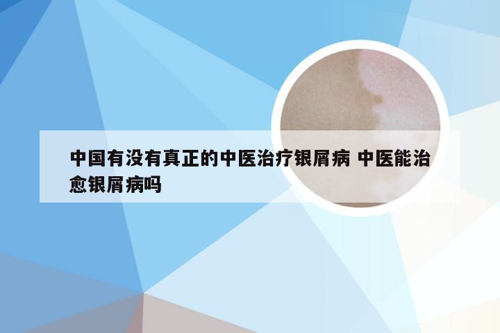 中国有没有真正的中医治疗银屑病 中医能治愈银屑病吗