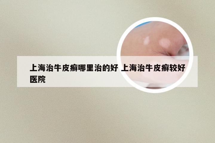 上海治牛皮癣哪里治的好 上海治牛皮癣较好医院