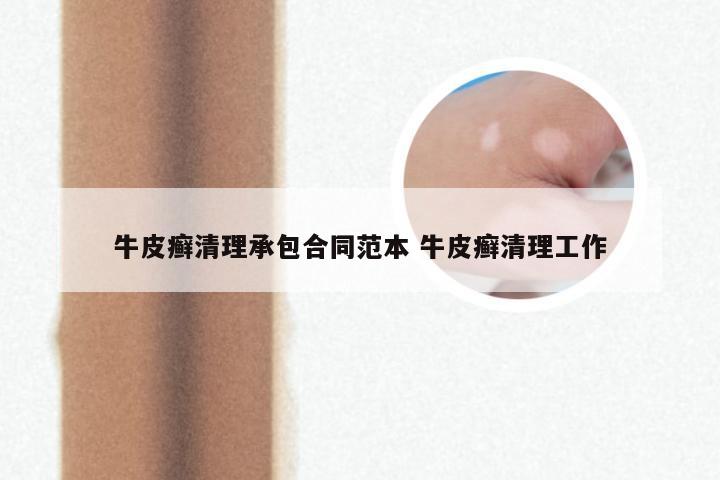 牛皮癣清理承包合同范本 牛皮癣清理工作