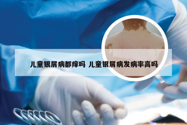 儿童银屑病都痒吗 儿童银屑病发病率高吗