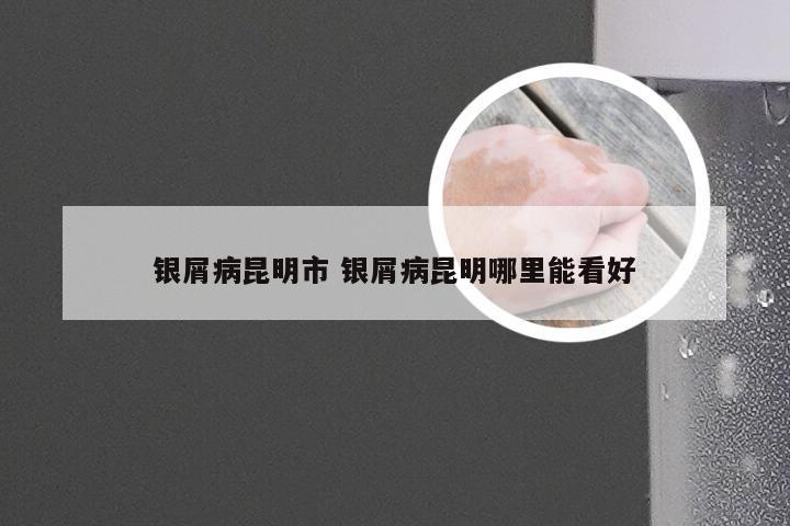 银屑病昆明市 银屑病昆明哪里能看好