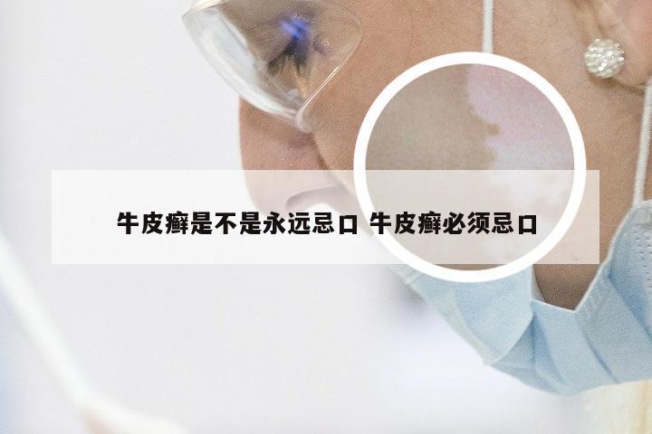 牛皮癣是不是永远忌口 牛皮癣必须忌口