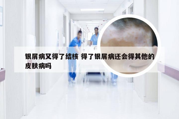 银屑病又得了结核 得了银屑病还会得其他的皮肤病吗