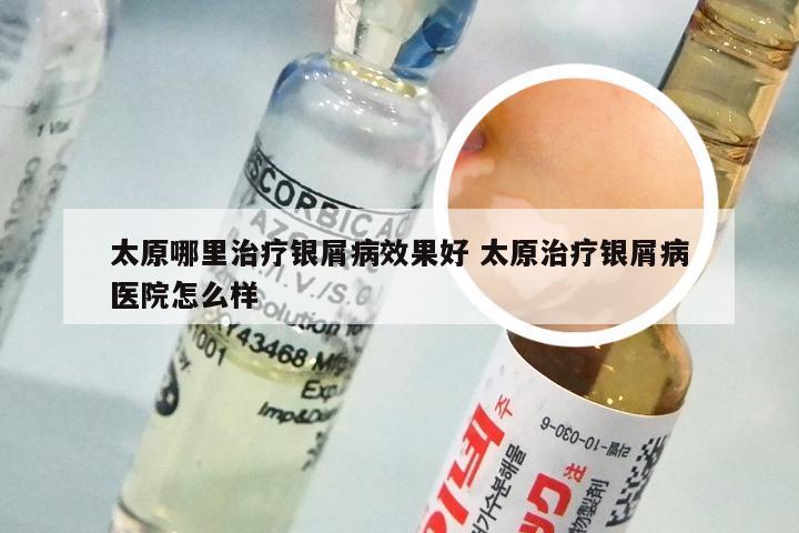 太原哪里治疗银屑病效果好 太原治疗银屑病医院怎么样