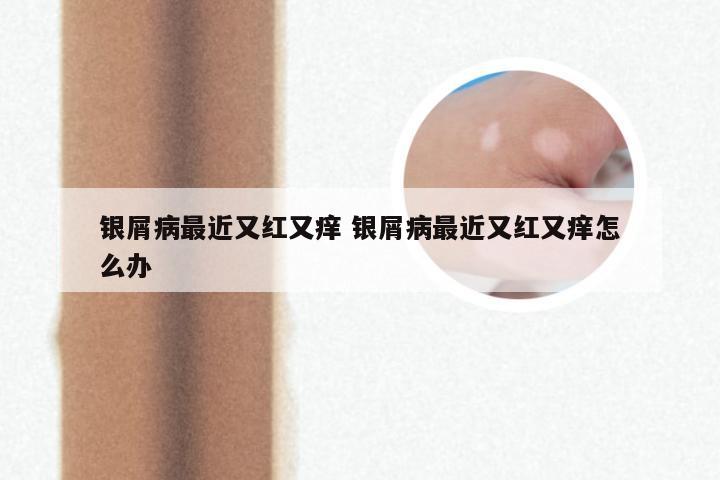 银屑病最近又红又痒 银屑病最近又红又痒怎么办