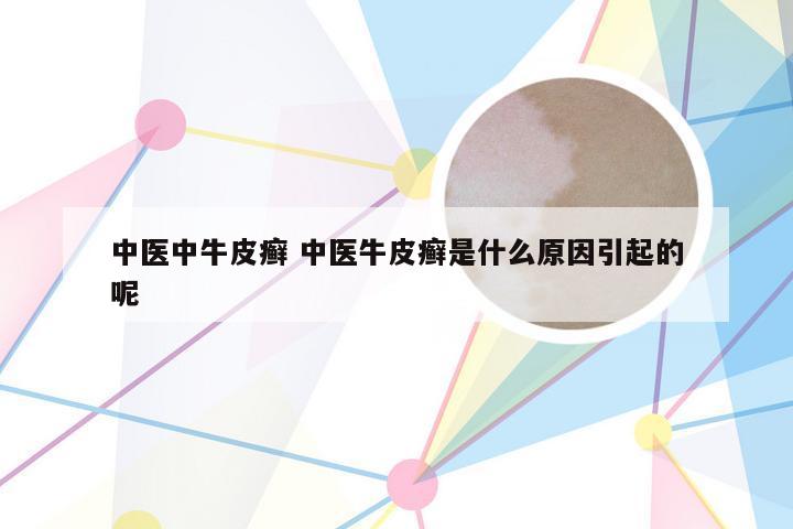 中医中牛皮癣 中医牛皮癣是什么原因引起的呢