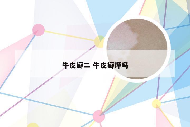 牛皮癣二 牛皮癣痒吗