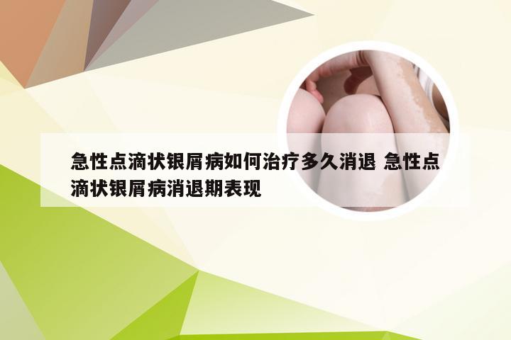 急性点滴状银屑病如何治疗多久消退 急性点滴状银屑病消退期表现