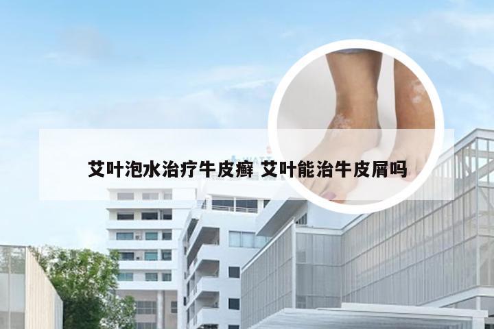 艾叶泡水治疗牛皮癣 艾叶能治牛皮屑吗