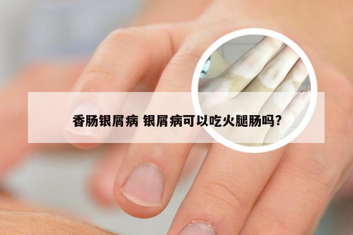 香肠银屑病 银屑病可以吃火腿肠吗?