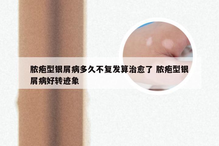 脓疱型银屑病多久不复发算治愈了 脓疱型银屑病好转迹象