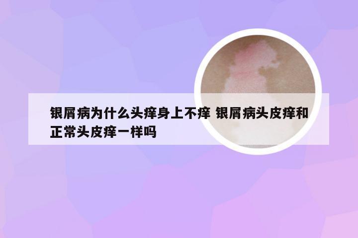 银屑病为什么头痒身上不痒 银屑病头皮痒和正常头皮痒一样吗