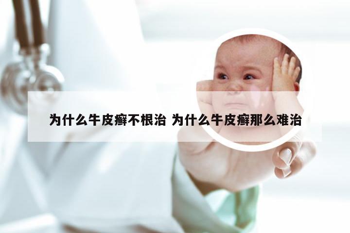 为什么牛皮癣不根治 为什么牛皮癣那么难治