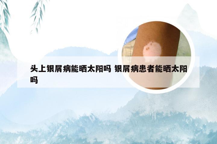 头上银屑病能晒太阳吗 银屑病患者能晒太阳吗
