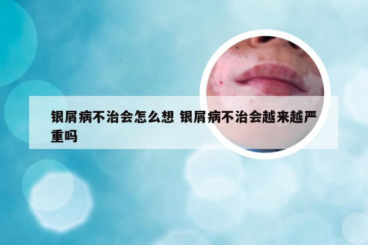 银屑病不治会怎么想 银屑病不治会越来越严重吗